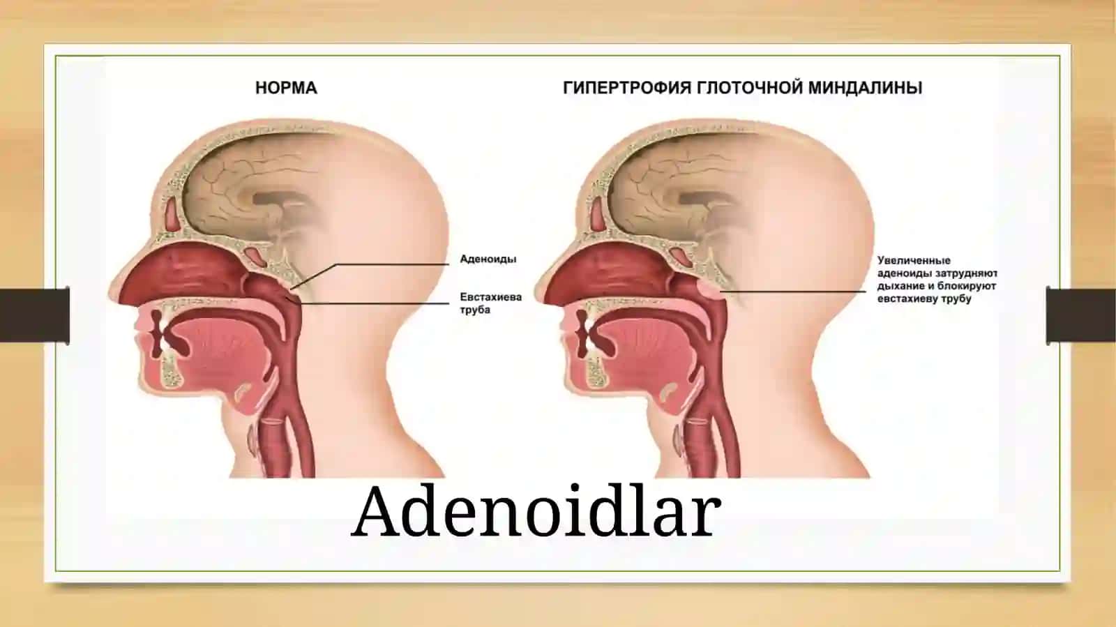 Adenoidlar 2