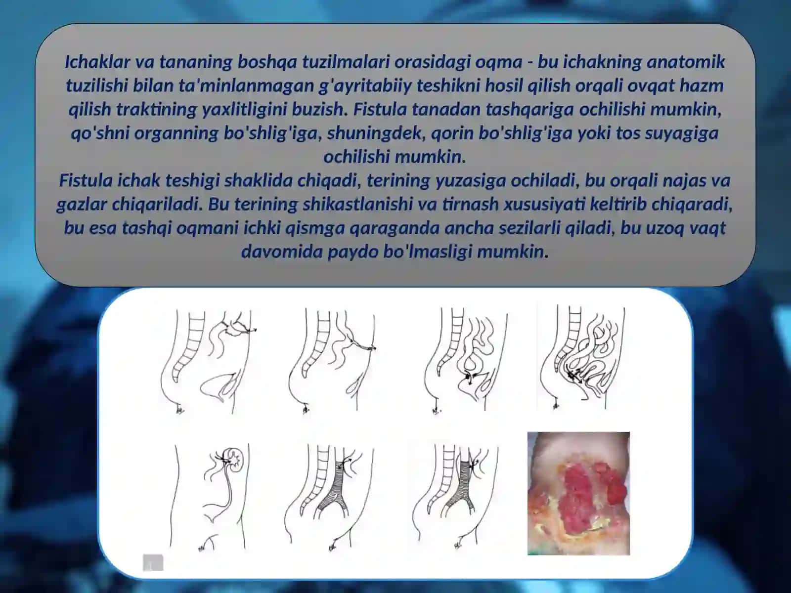 Ichakoqmayaralari 2