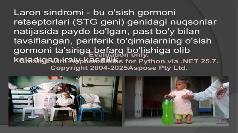 Laron Sindromi 2