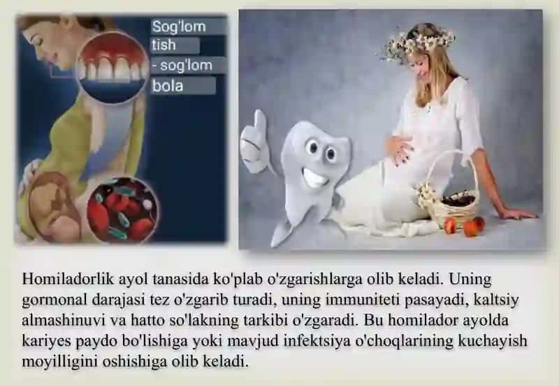 Homiladorlik davrida kariyesning individual profilaktikasi 2
