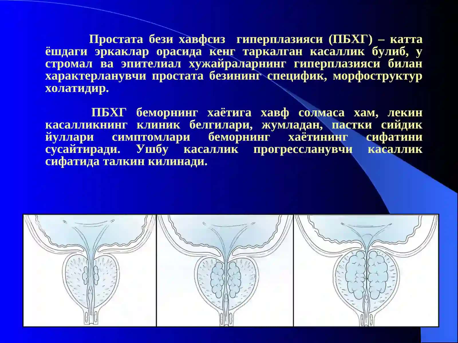 Простата бези хавфсиз гиперплазияси 2