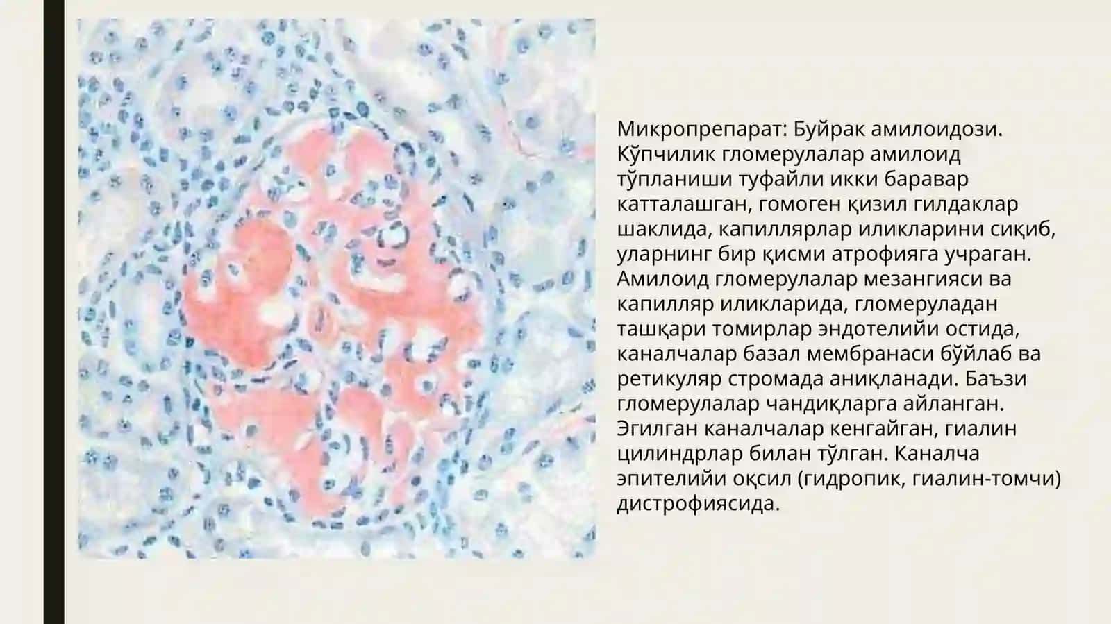 Макропрепарат: Сурункали атрофик гастрит 2