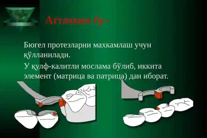 Аттачменларни қўллаган ҳолдаёйли (бюгель) протезларини тайёрлаш 2