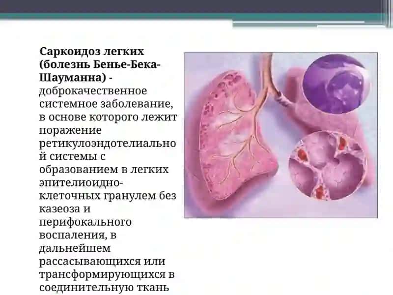 Саркоидоз легких 2