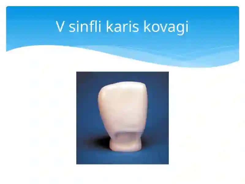 Blek bo‘yicha V sinfli karies kovaklarini restavratsiya qilishning klinik tamoyillari. 2