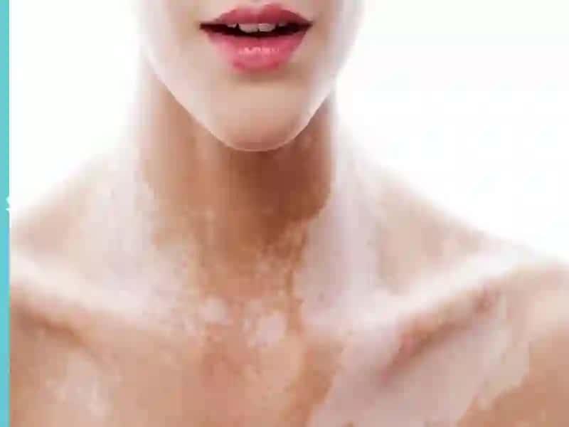 VITILIGO HAQIDA 2