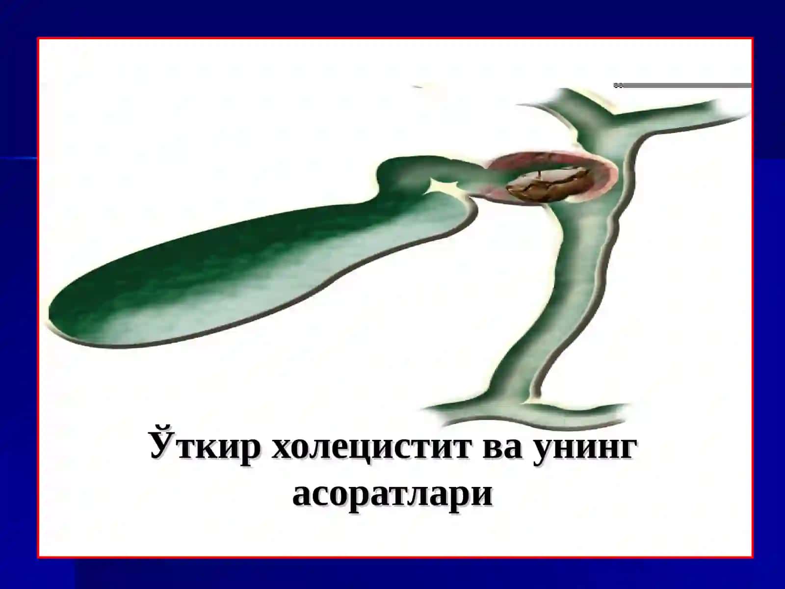 Ўткир холецистит,ўт тош касаллиги клиникаси, ташхисқўйиш, солиштирма ташхис ва даволаш. Сурункали холецистит 2
