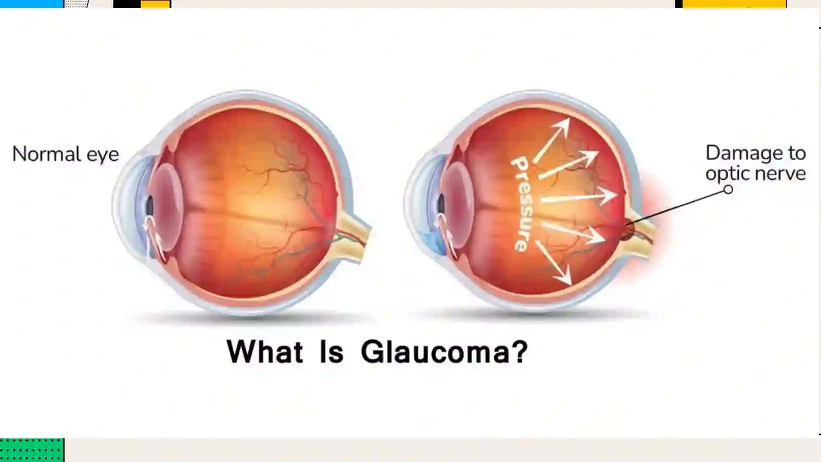 Birlamchi Glaukoma 2
