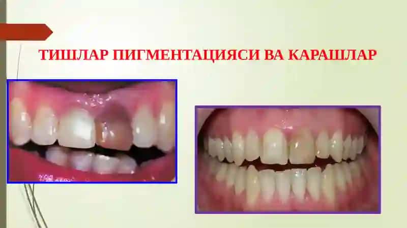 Ранги узгарган тишларни  оқартириш. Кўрсатма ва қарши кўрсатмалар. Қўллаш услублари 2
