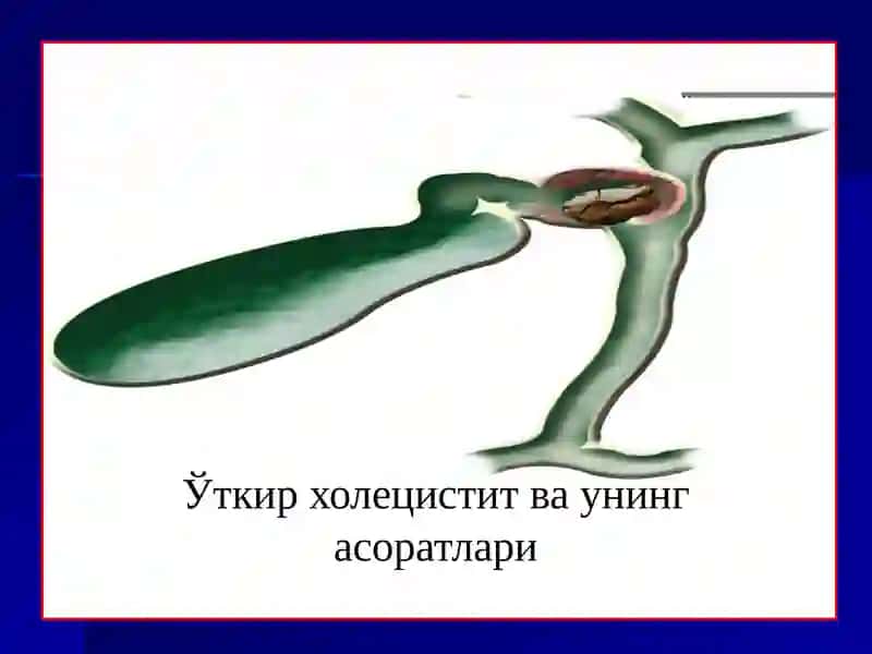 ЎТКИР ХОЛЕЦИСТИТ 2