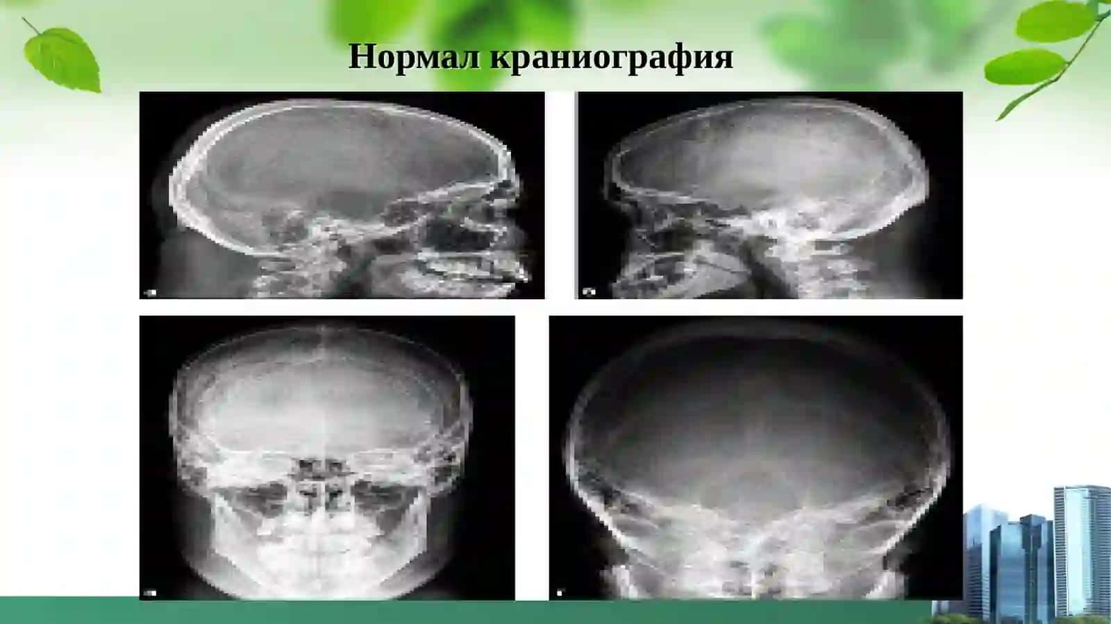 НЕЙРОХИРУРГИК ТЕКШИРИШ МЕТОДЛАРИ 2