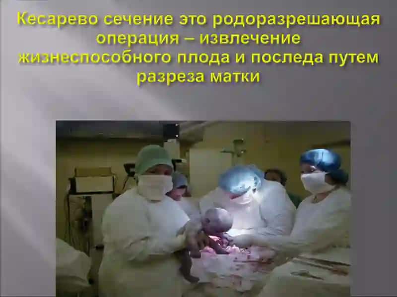 КЕСАРЕВО СЕЧЕНИЕ 2