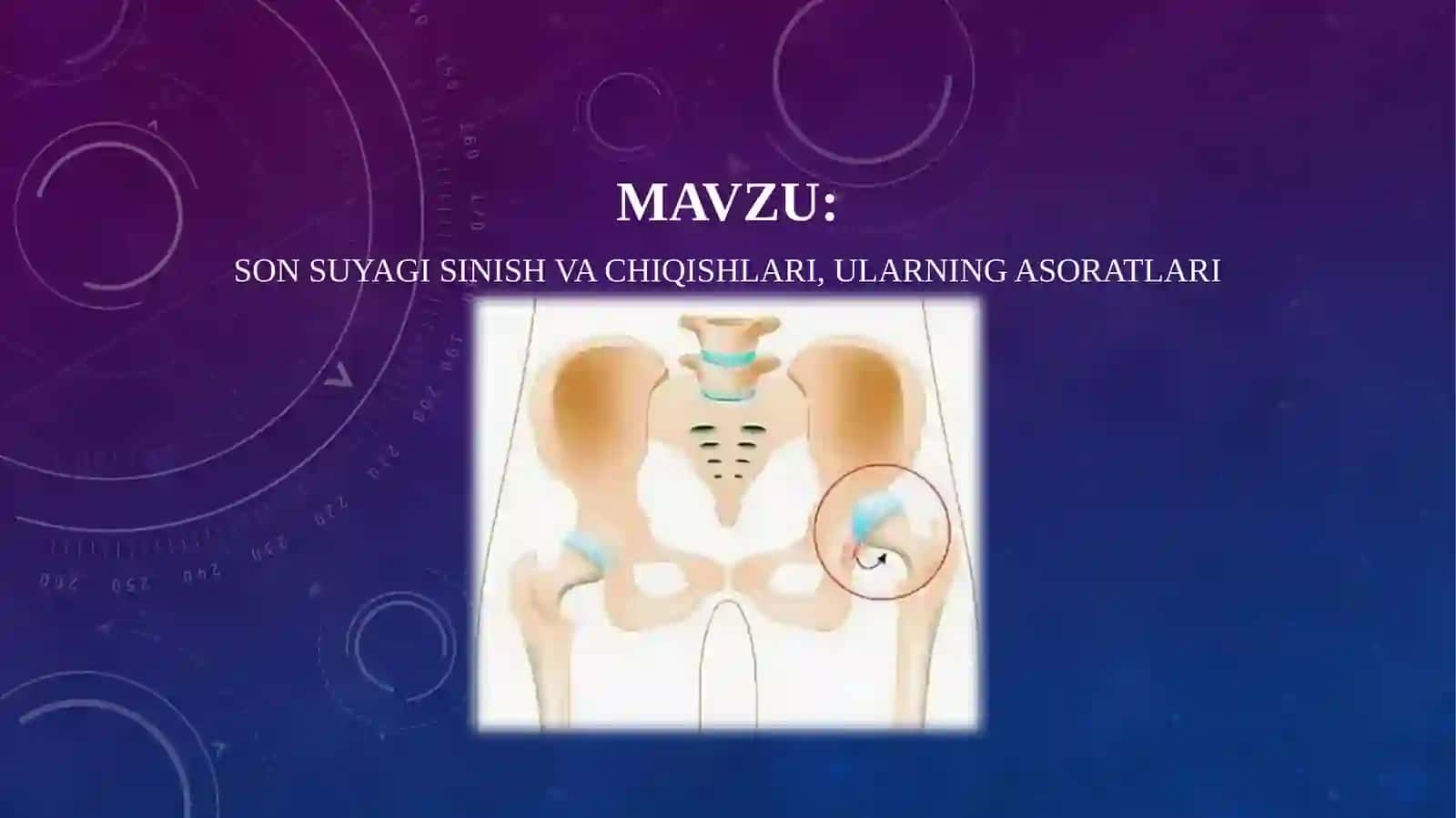 Son suyagi sinish va chiqishlari, ularning asoratlarI 2