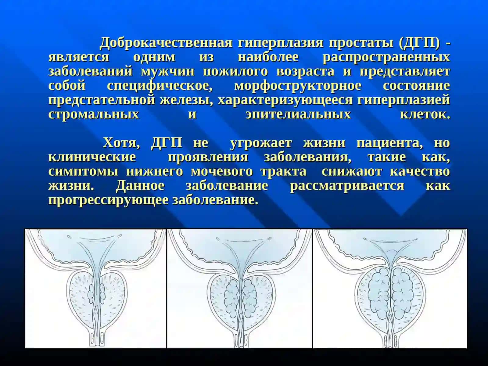 ДОБРОКАЧЕСТВЕННАЯ ГИПЕРПЛАЗИЯ ПРОСТАТЫ 2