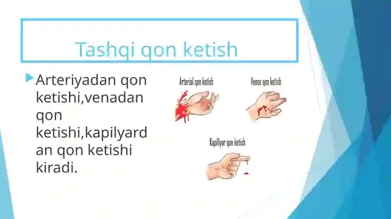 Qon ketish turlari va usullari 2