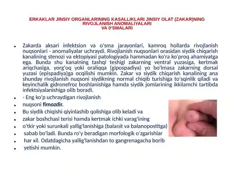 ERKAKLAR JINSIY ORGANLARINING KASALLIKLARI JINSIY OLAT (ZAKAR)NING RIVOJLANISH ANOMALIYALARIVA O‘SMALARI 2