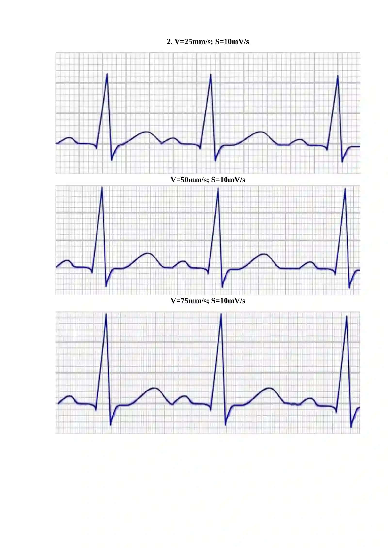 V=25mm/s; S=10mV/s 2