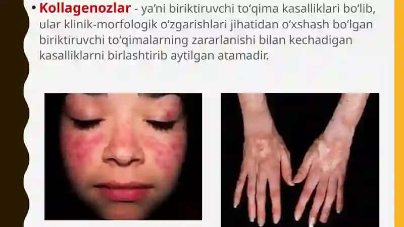 Kollagenoz, patogenezi, tashxisi 2
