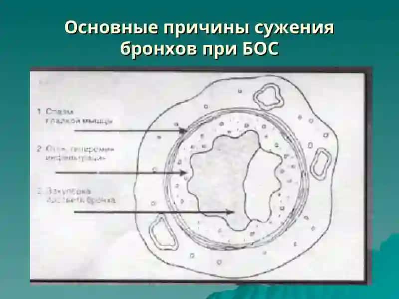 Тема лекции: Синдром бронхообструкции 2