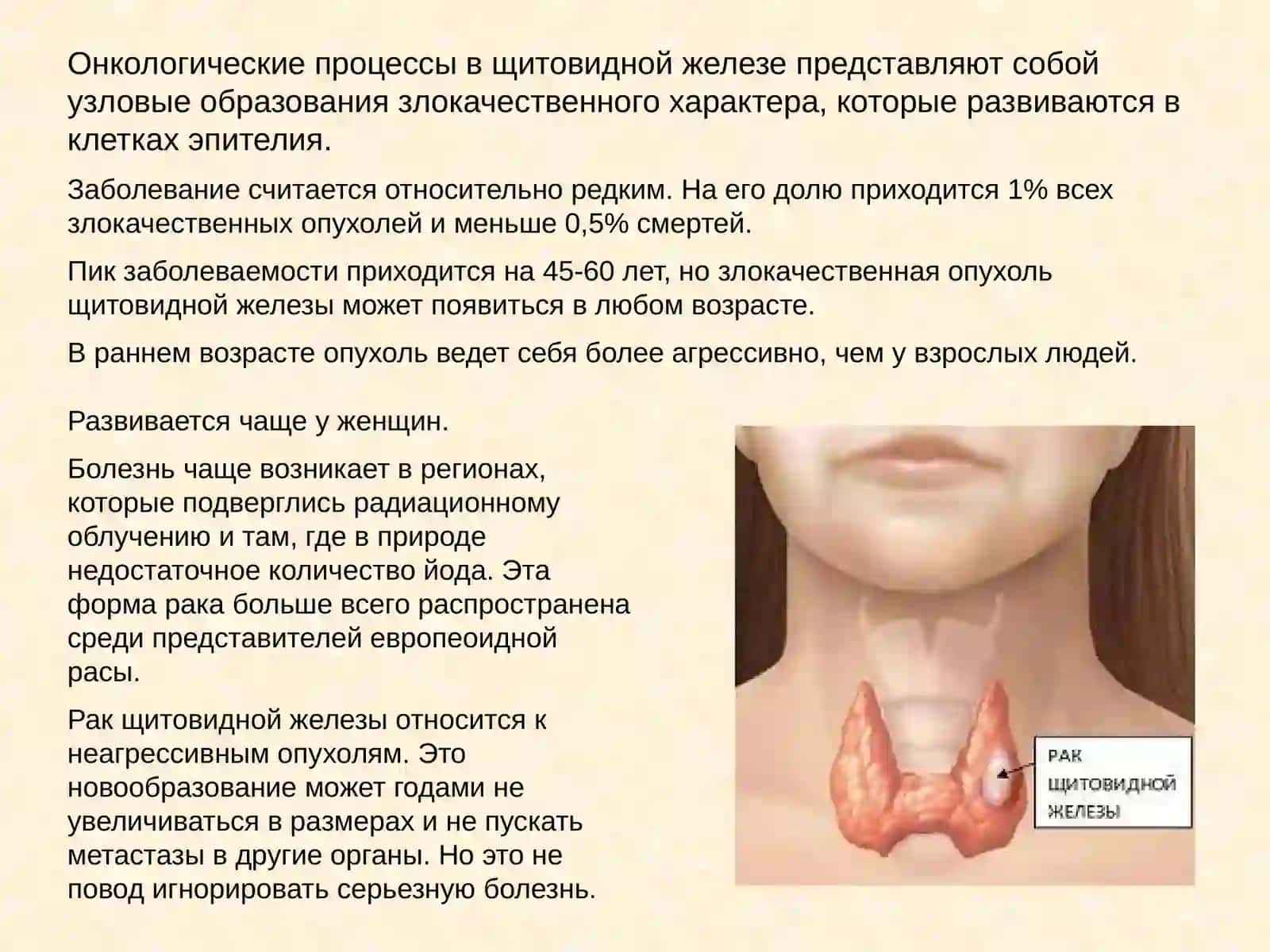 Рак щитовидной железы 2