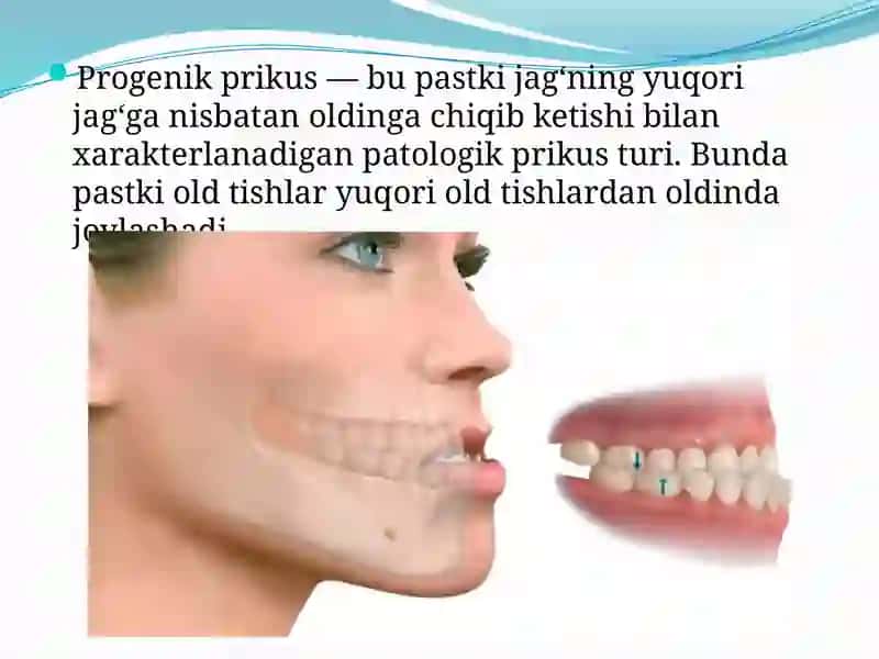 Progenik prikus 2