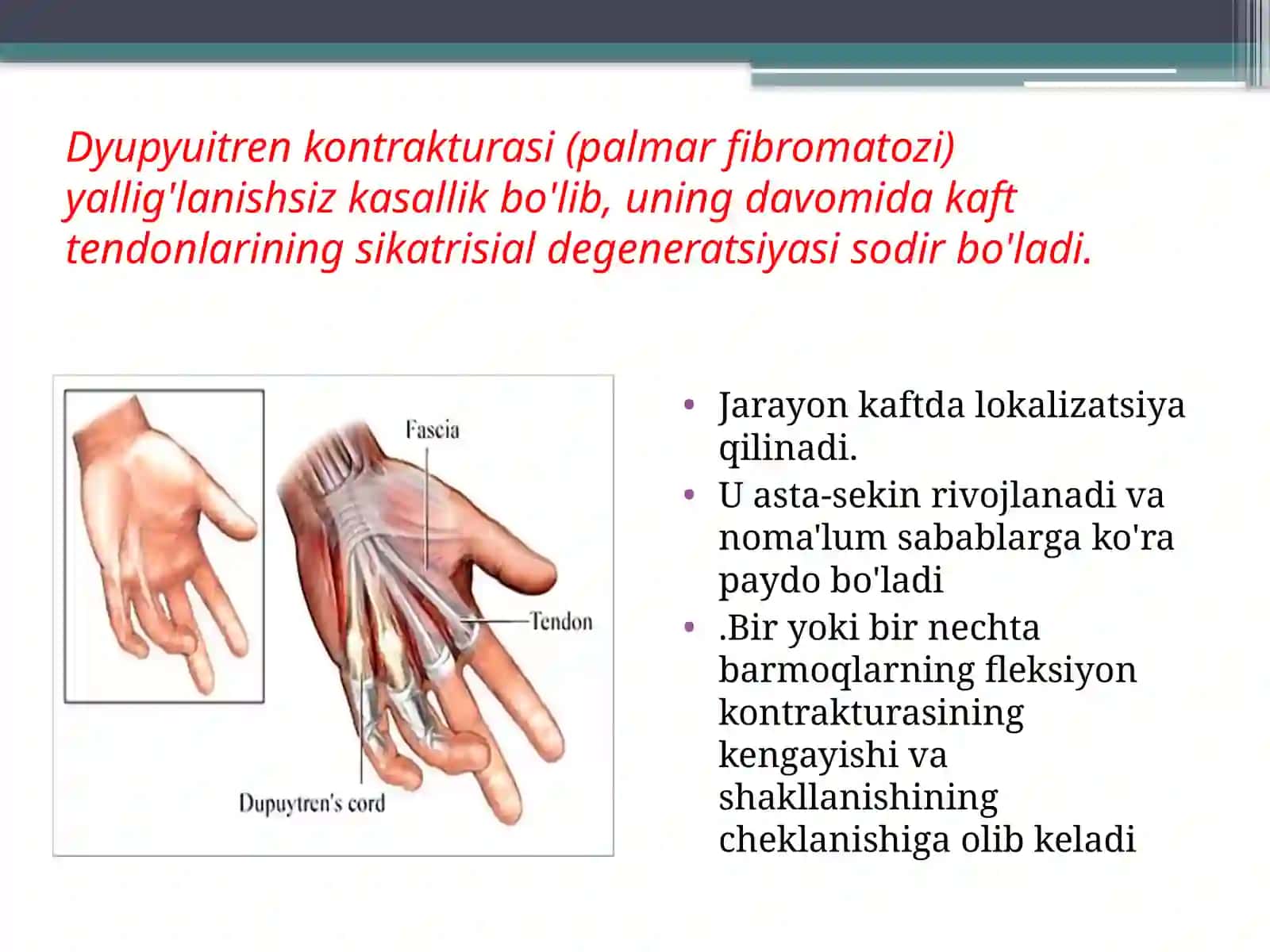 Dyupyuitren kontrakturasi 2