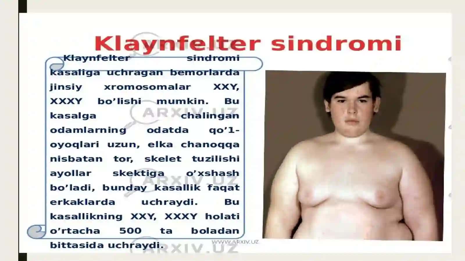 Klaynfelter sindromi 2