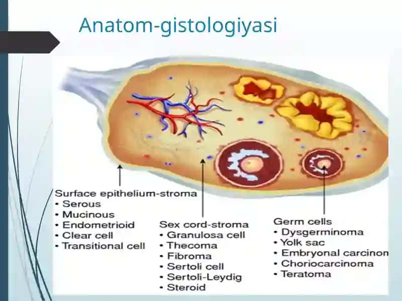 Tuxumdon yaxshi va yomon sifatli o'smalari. Kista va kistomalar 2