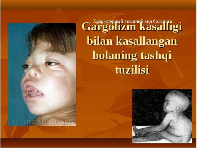 GEMOFILIYA KASALLIGI 2