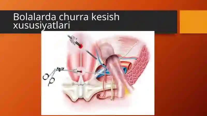 Bolalarda churra kesish xususiyatlari 2