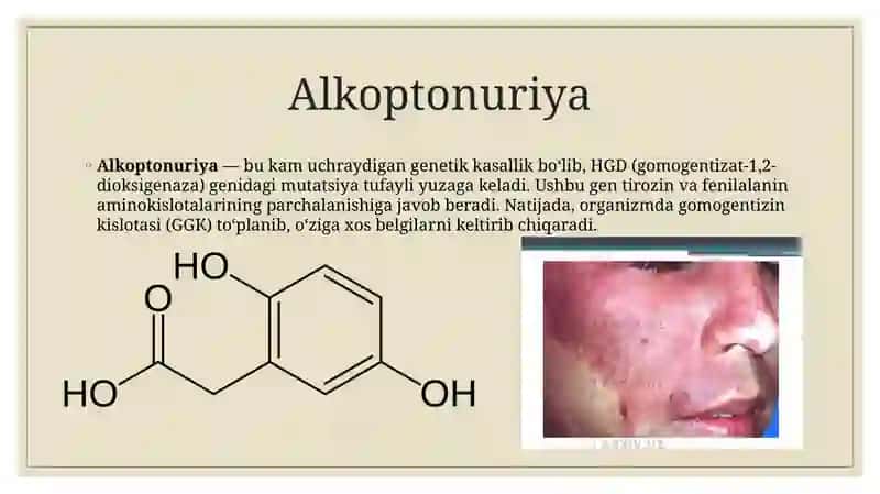 Alkoptonuriya 2