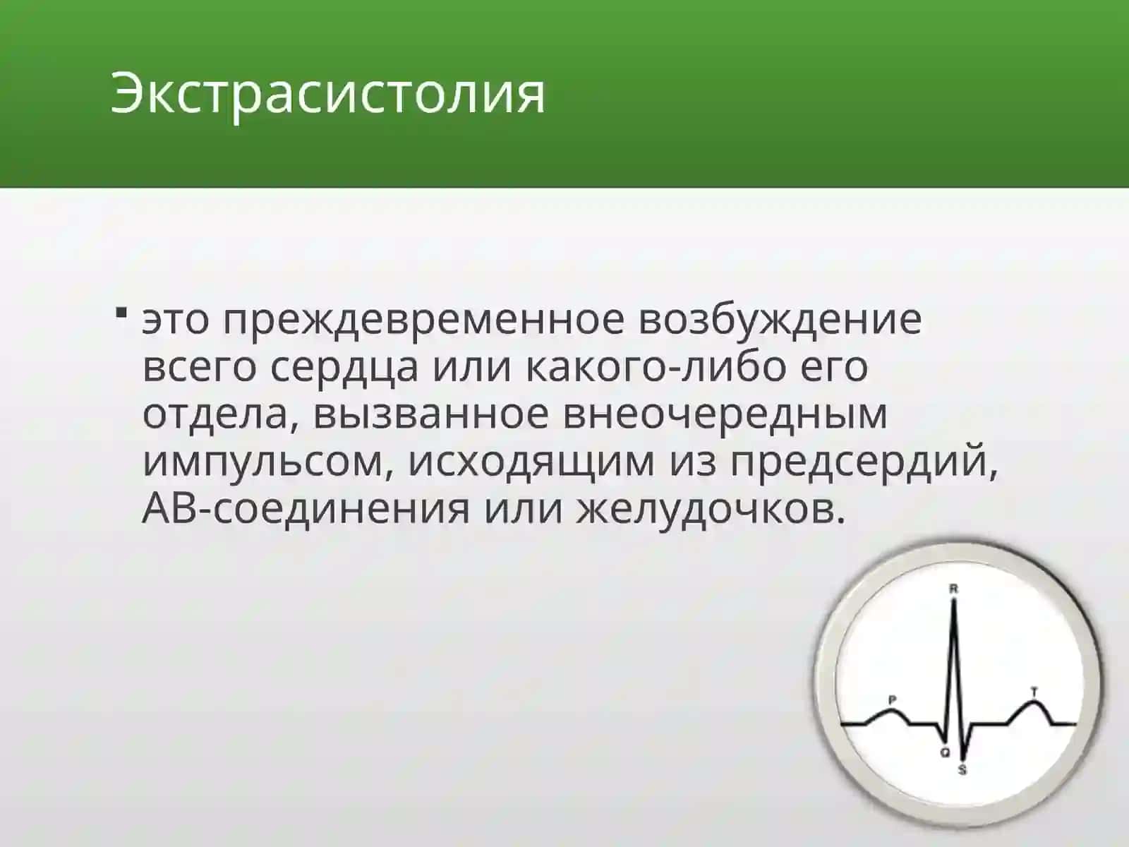 Экстрасистолии 2