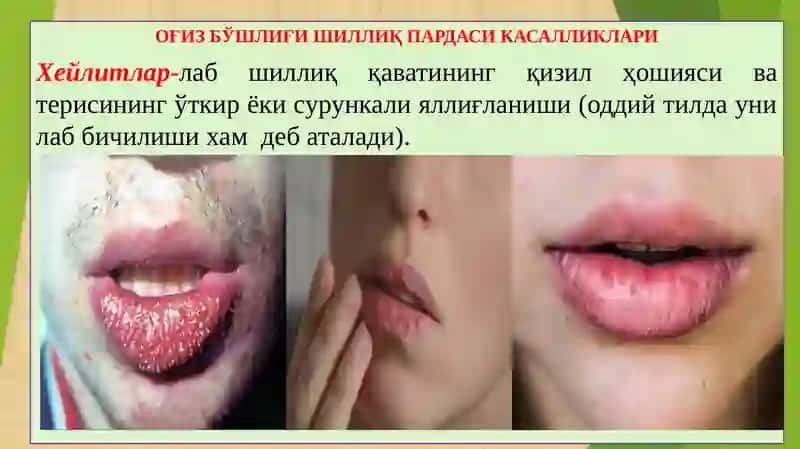 Оғиз бўшлиқи шиллиқ пардаcи касалликлари 2