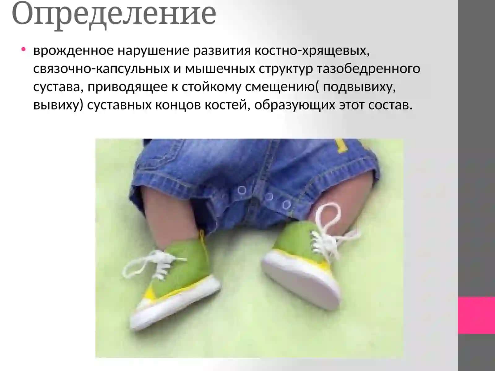Врожденный вывих бедра(дисплазия тазобедренного сустава) 2