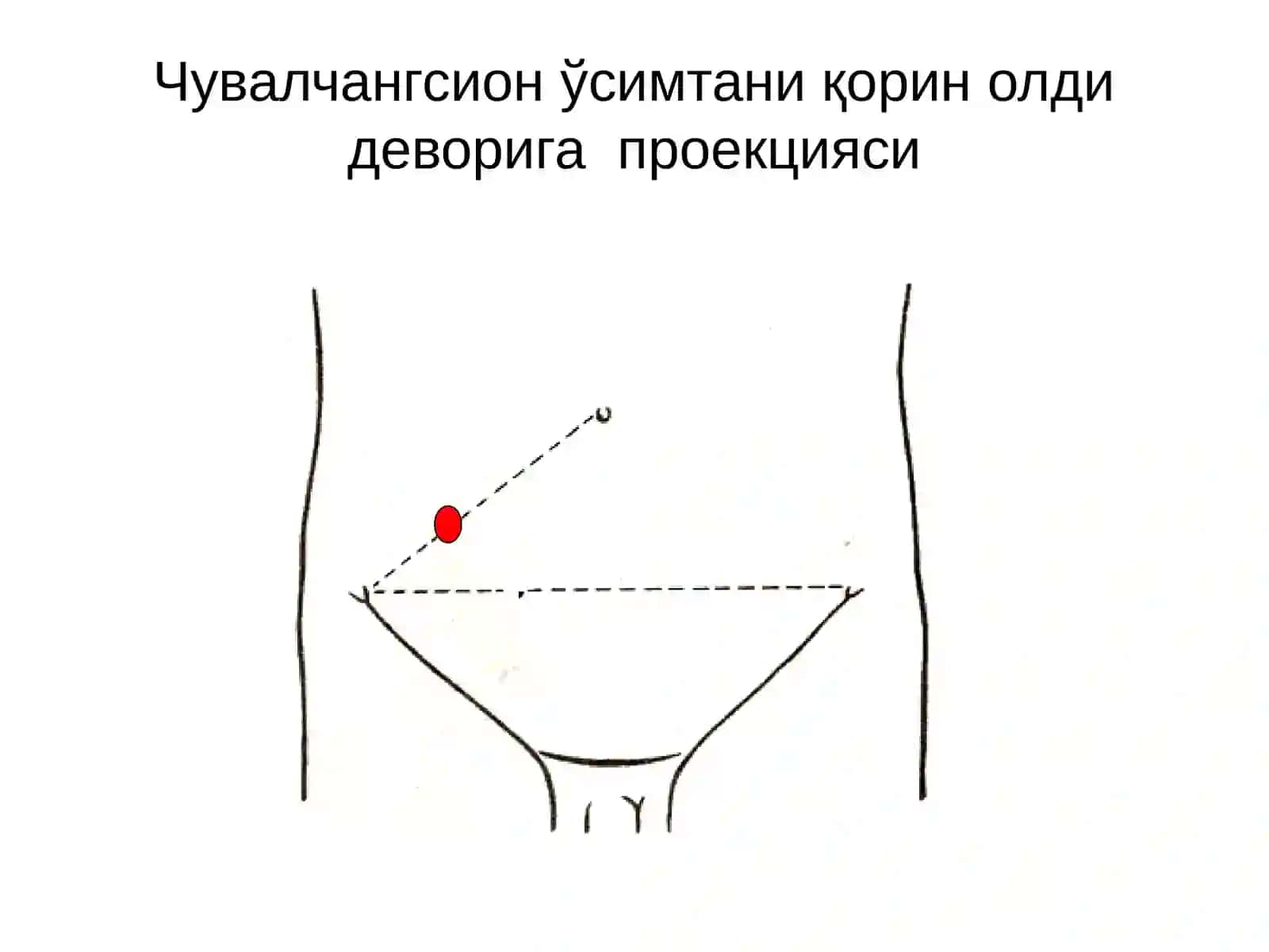 Ўткир аппендицит-чувалчангсимон ўсимтанинг ўткири носпецифик яллиғланиши 2