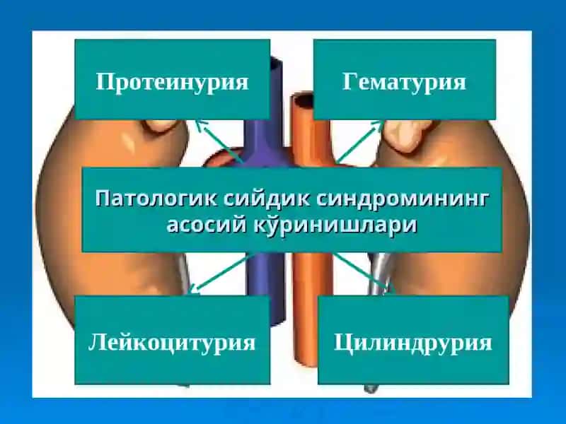 Сийдик чўкмасидаги ўзгаришлар билан кечадиган касалликларни қиёсий ташҳислаш 2
