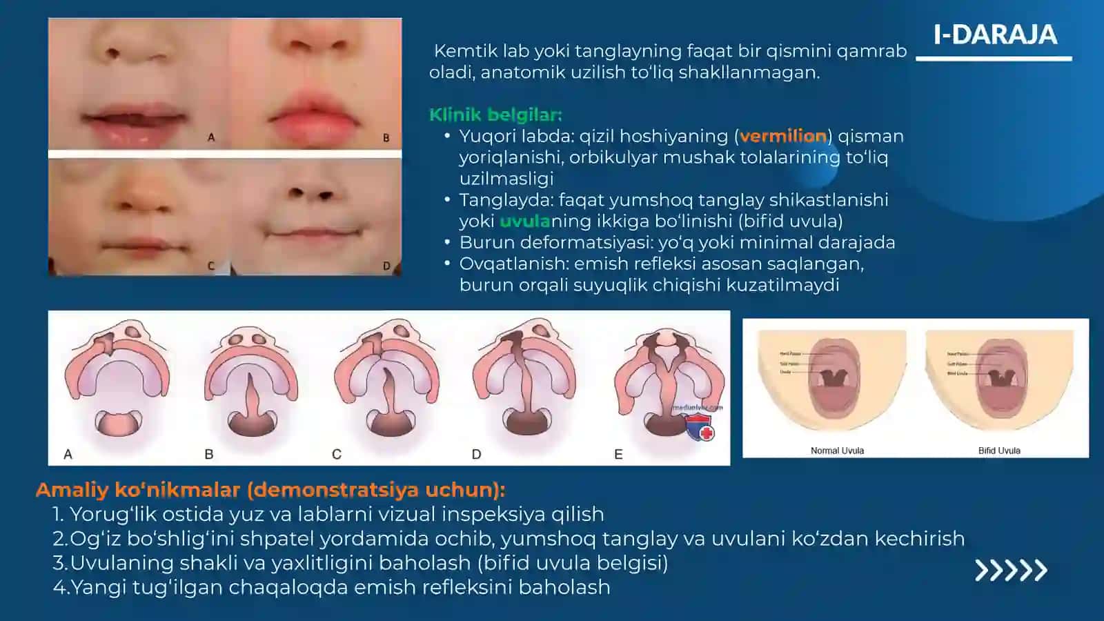 Yuqori labva tanglayning tug‘ma kemtiklarida tashxislash 2