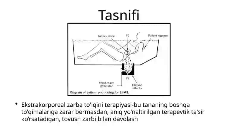 Ekstrakorporal zarb to'lqinlilitotripsiya 2