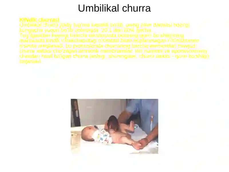 Umbilikal Churra 2