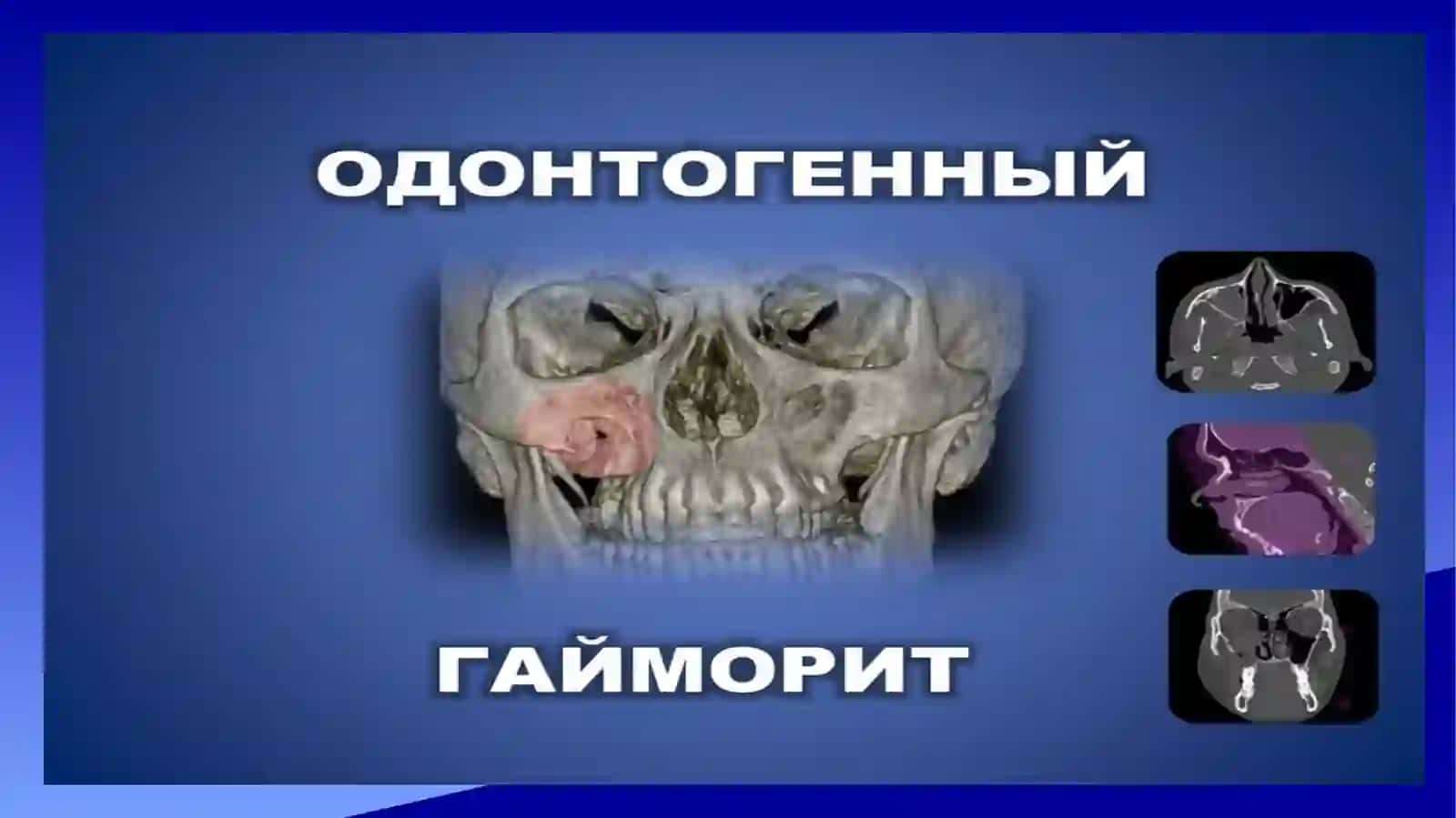 Odontogen gaymorit. Tashxislash va davolash usullari algoritmlari 2
