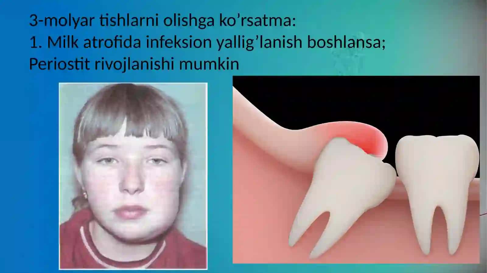 Uchinchi molyar tishlarni olishga ko’rsatma va olish usullari 2