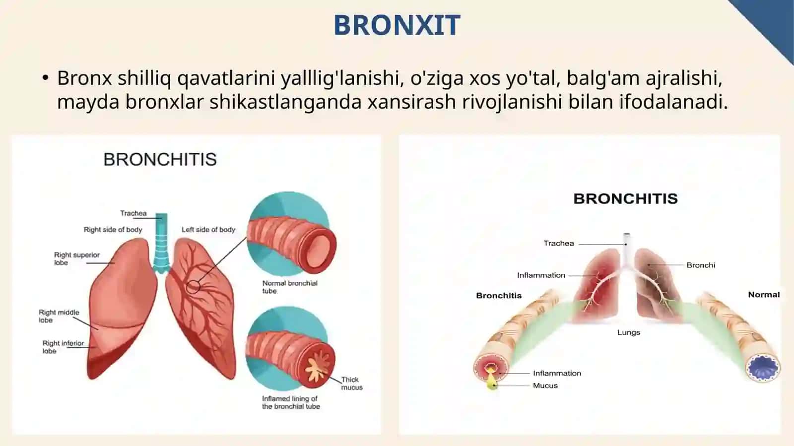 O’tkirbronxitlar.Etiopatogeneztasnifistandarttashxislash.Standartvaindividualdavochoralari.Bronxobstruktivsindrom.Qiyosiytashxislashretsiduvlanuvchiobstruktivbronxitlar.Bronxiolit.Obstruktivbronxitlar 2