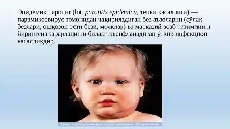 ЭПИДЕМИК ПАРОТИТ(Тепки) 2
