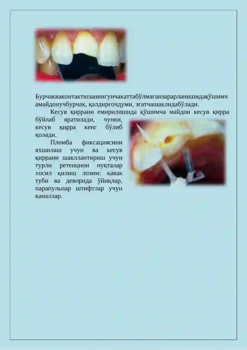 Блэк бўйича IV синфли кариес кавакларини реставрация қилишнинг клиник тамойиллари 2