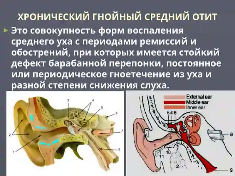 Хронический гнойный средний отит. Тимпанопластика.Отогенные внутричерепные осложнения 2