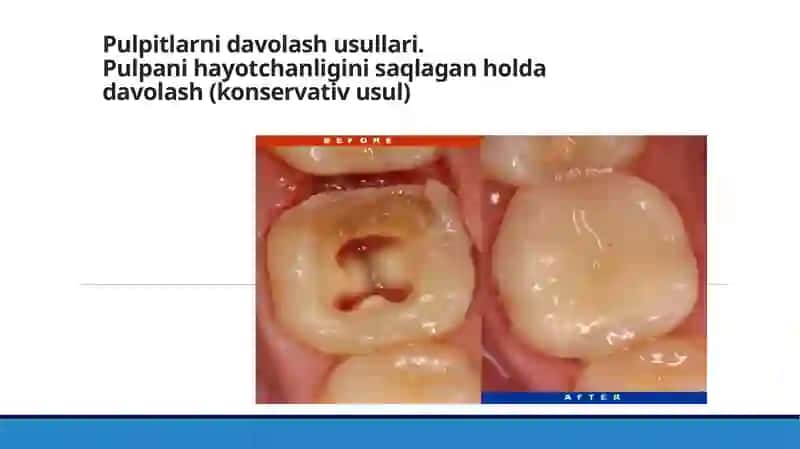 Pulpitlarni Vital amputatsiya usuli bilan davolash. Ko’rsatma. O’tkazish texnikasi.Pulpitlarni Vital amputatsiya usuli bilan davolashda yuzaga kelauvchi xato asoratlar 2