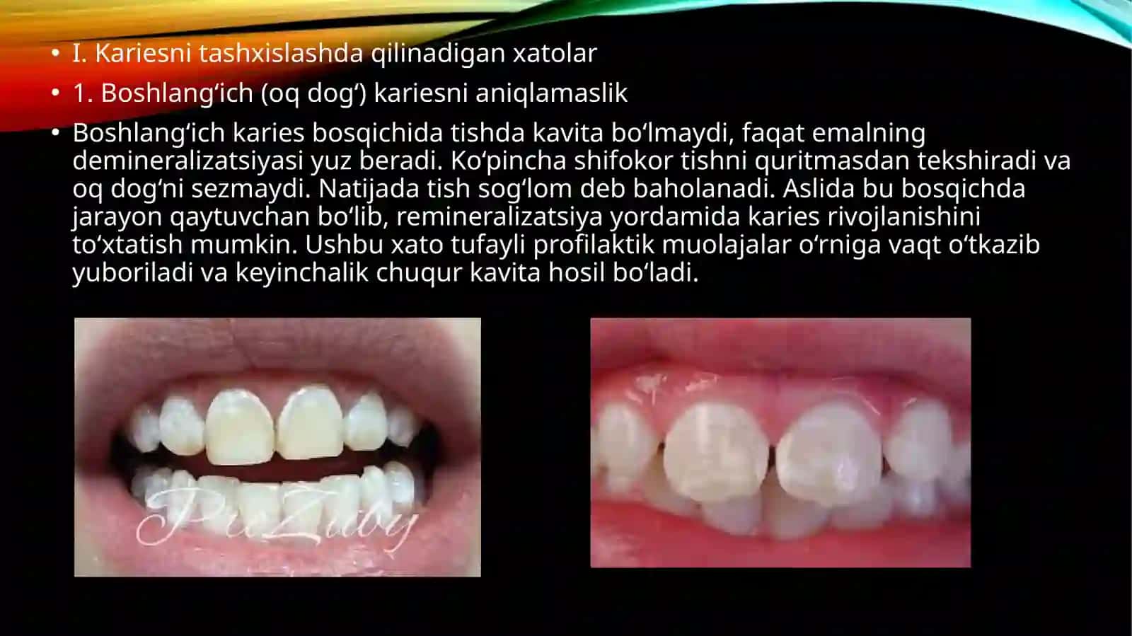 Kariyes kasalligini tashxislashda va davolashda uchraydigan xato va asoratlar.Kariyes kasalligini profilaktikasi.Kariyesni profilaktik omillar guruhi haqida malumot 2