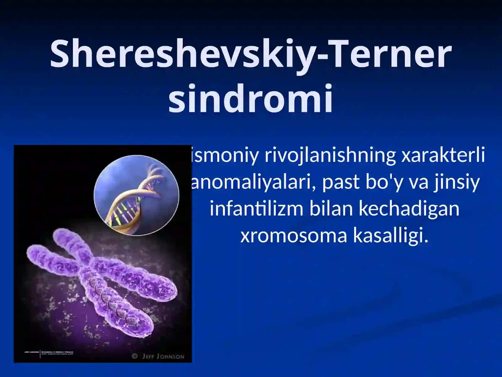 Shereshevskiy-Tеrner sindromi 2