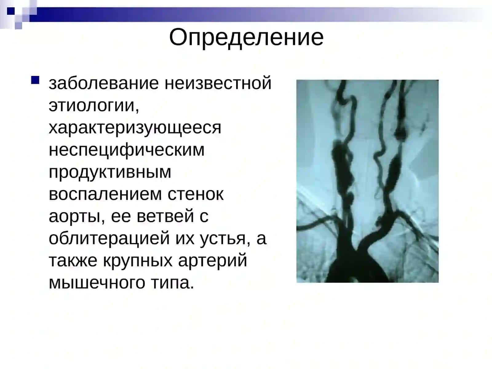 Болезнь Такаясу (неспецифический аортоартериит,синдром дуги аорты) 2
