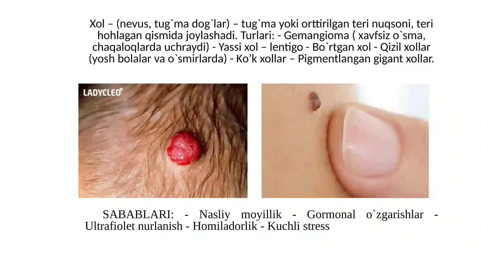 Nevus (xol) 2